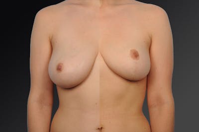 Breast Lift (Mastopexy) Before & After Gallery - Patient 106358500 - Image 1