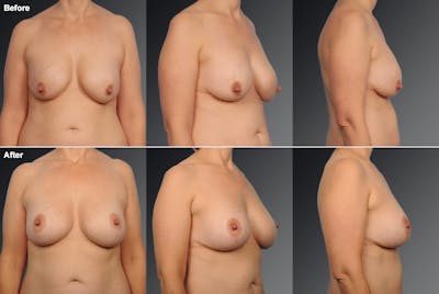 Breast Lift (Mastopexy) Before & After Gallery - Patient 106358502 - Image 1
