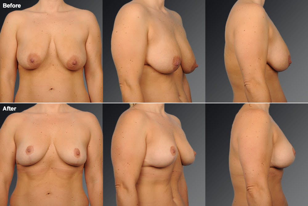 Breast Lift (Mastopexy) Before & After Gallery - Patient 106358503 - Image 1