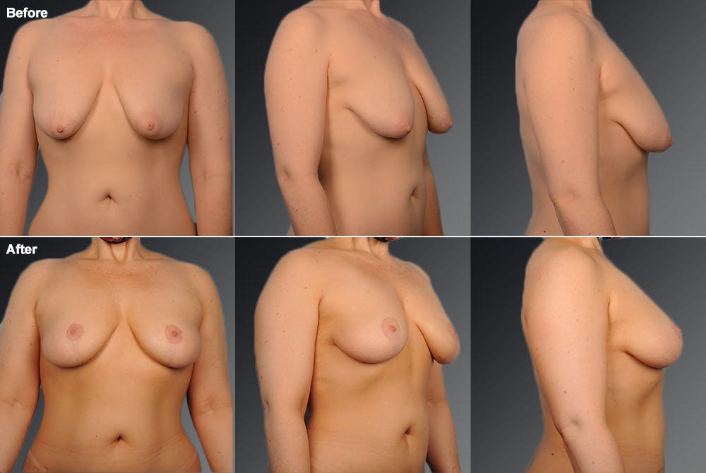 Breast Lift (Mastopexy) Before & After Gallery - Patient 106358504 - Image 1