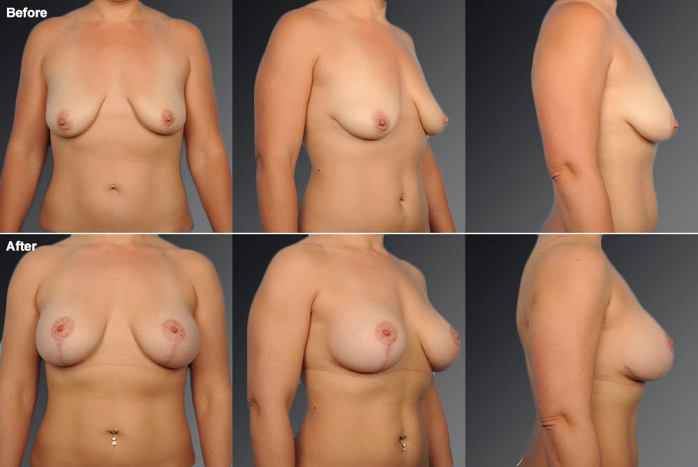 Breast Lift (Mastopexy) Before & After Gallery - Patient 106358505 - Image 1