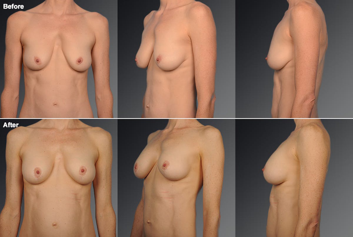 Breast Lift (Mastopexy) Before & After Gallery - Patient 106358518 - Image 1