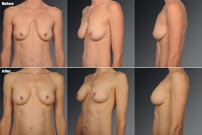 Breast Lift (Mastopexy) Before & After Gallery - Patient 106358518 - Image 1
