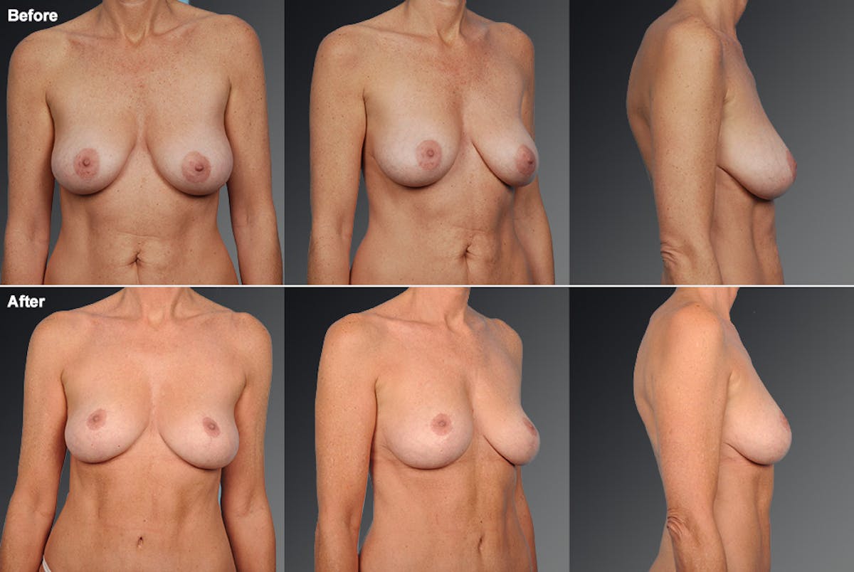 Breast Lift (Mastopexy) Before & After Gallery - Patient 106358523 - Image 1