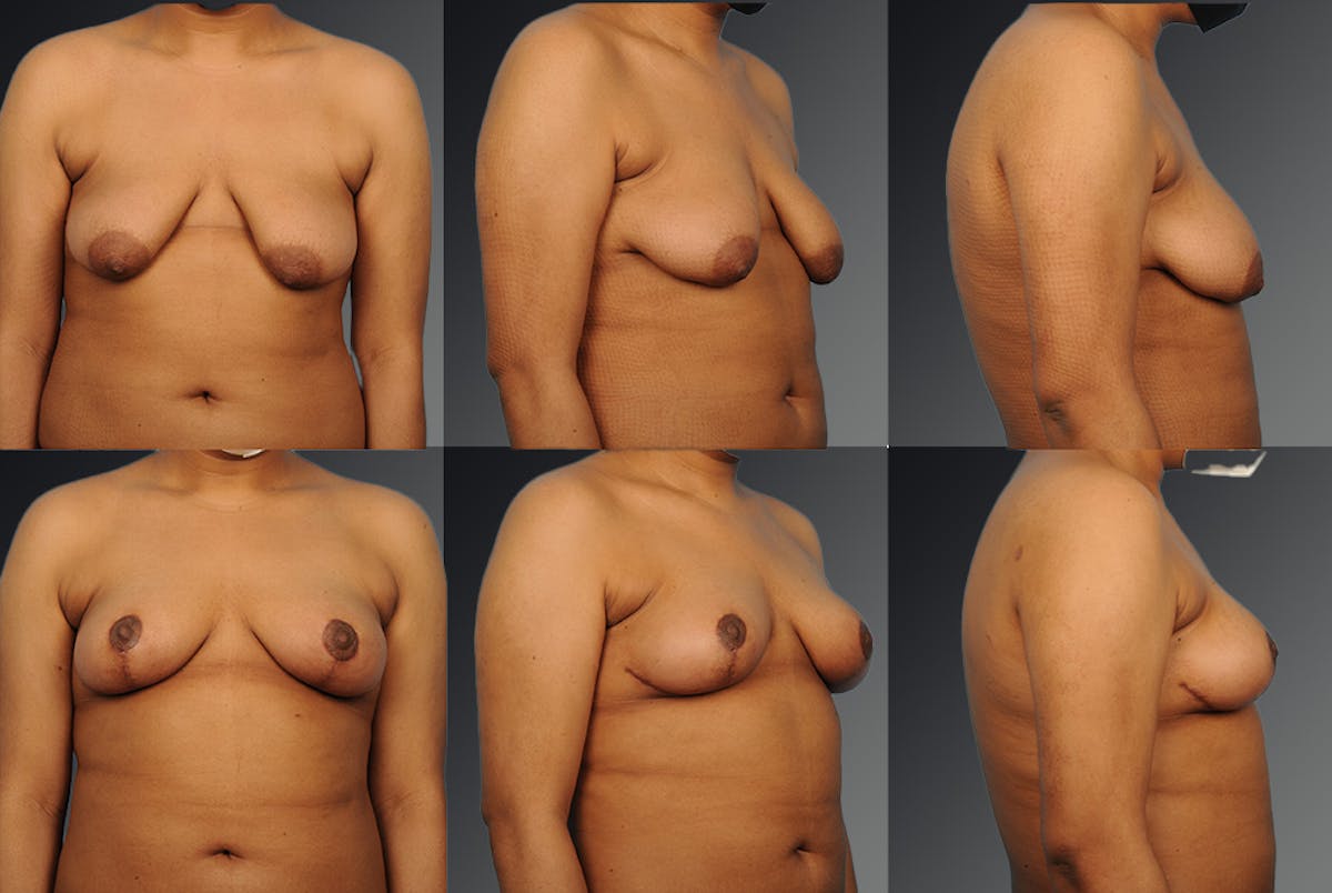 Breast Lift (Mastopexy) Before & After Gallery - Patient 106358539 - Image 1