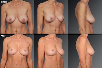 Breast Lift (Mastopexy) Before & After Gallery - Patient 106358546 - Image 1