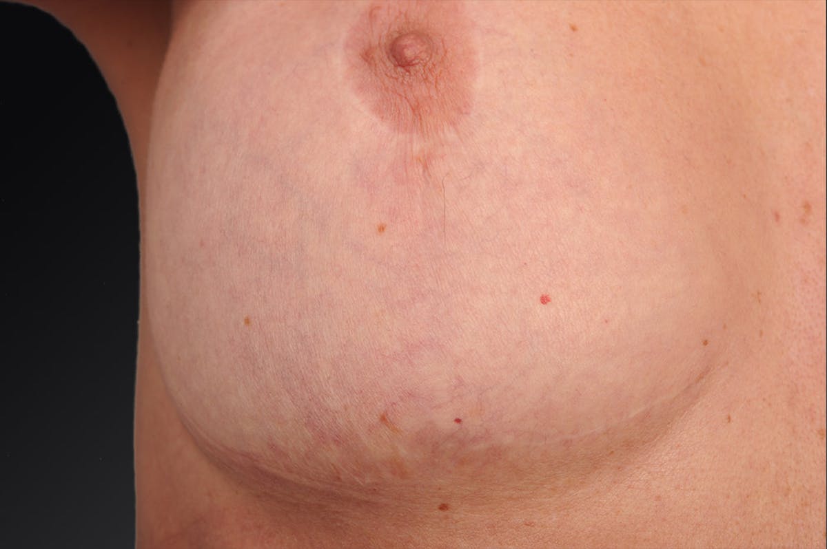 Breast Lift (Mastopexy) Before & After Gallery - Patient 106358547 - Image 1