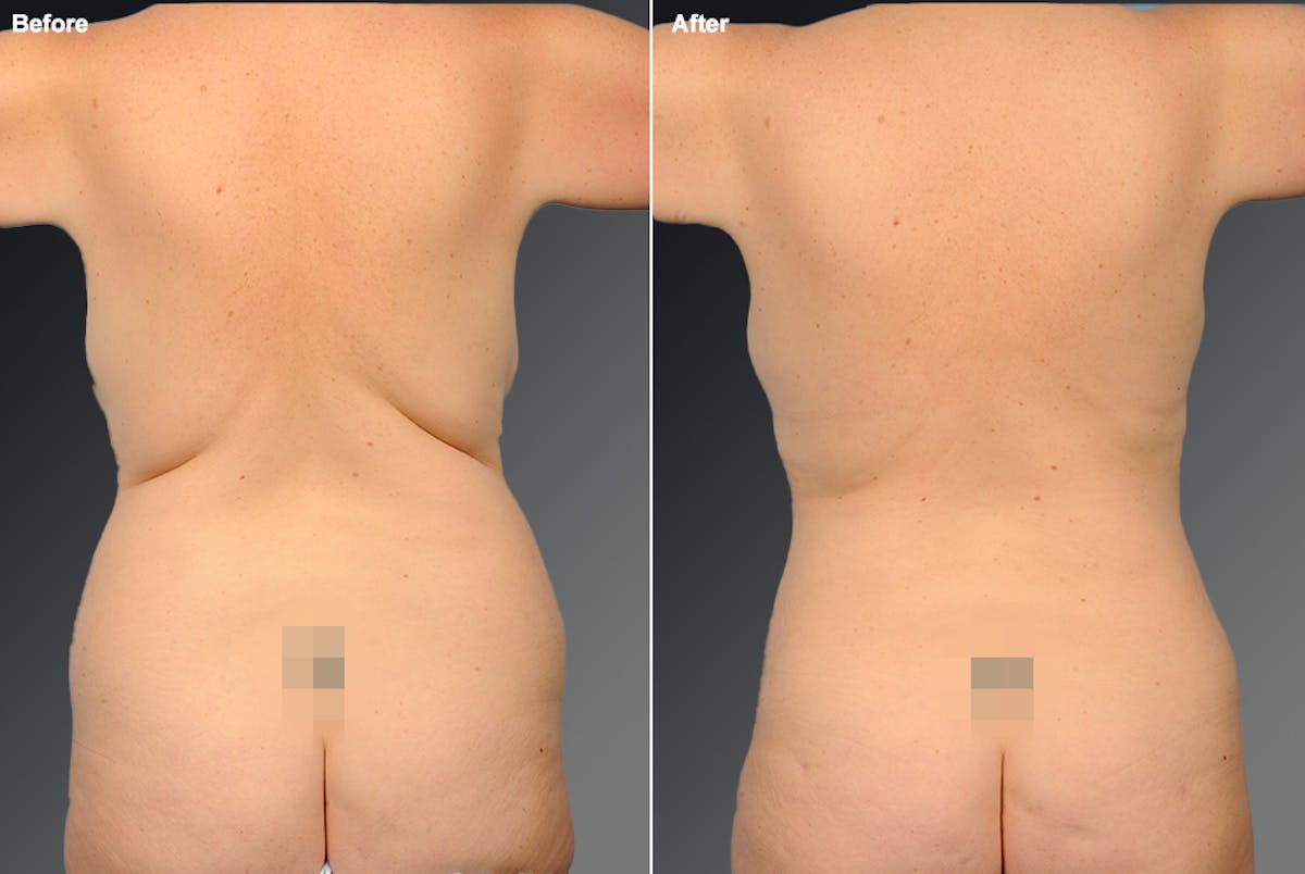 Liposuction Before & After Gallery - Patient 106009041 - Image 1