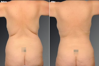Liposuction Before & After Gallery - Patient 106009041 - Image 1