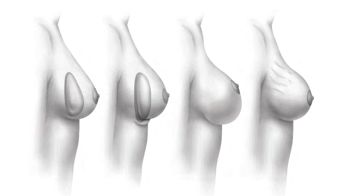 Breast diagram