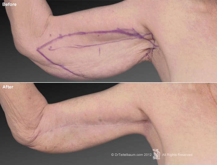 Arm lift before and after