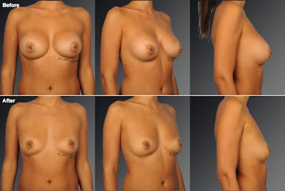 Breast Implant Revision Before & After Gallery - Patient 108616899 - Image 1