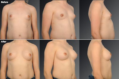 MTF Top Surgery/Transgender Before & After Gallery - Patient 108676471 - Image 1