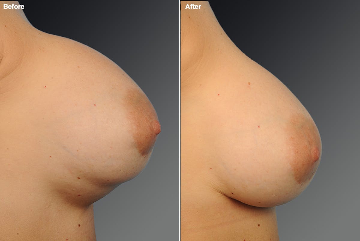 Breast Implant Revision Before & After Gallery - Patient 108616945 - Image 1