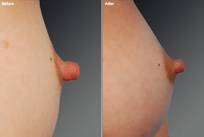 Nipple Reduction Before & After Gallery - Patient 108616978 - Image 1
