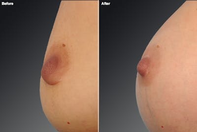 Inverted Nipple Before & After Gallery - Patient 119059858 - Image 1