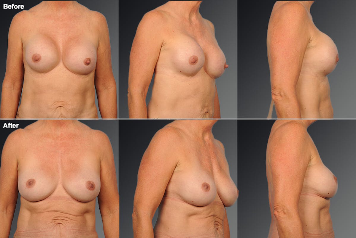 Breast Implant Revision Before & After Gallery - Patient 108616900 - Image 1