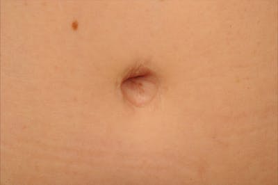 Body Scar Closeups Before & After Gallery - Patient 108676426 - Image 1