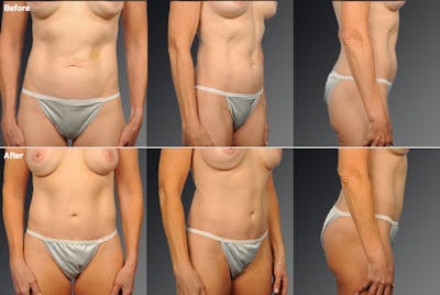 Tummy Tuck Before & After Gallery - Patient 108676440 - Image 1