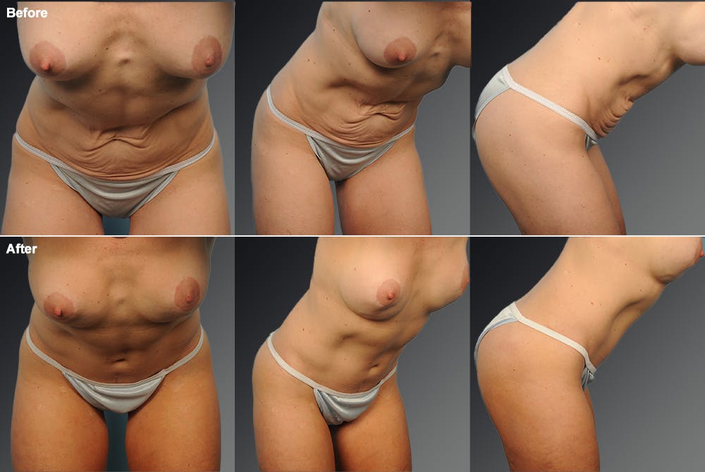 Tummy Tuck Before & After Gallery - Patient 108676441 - Image 1