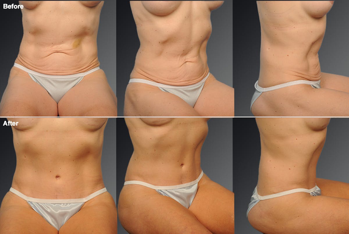 Tummy Tuck Before & After Gallery - Patient 108676442 - Image 1
