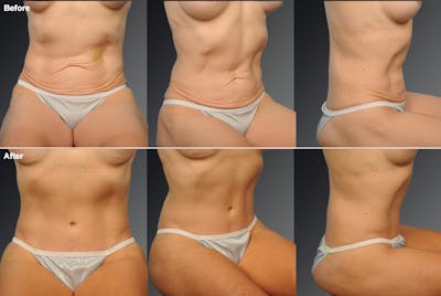 Tummy Tuck Before & After Gallery - Patient 108676442 - Image 1