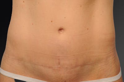 Tummy Tuck Before & After Gallery - Patient 108676427 - Image 1