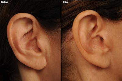 Face and Neck Lift Before & After Gallery - Patient 106009241 - Image 1