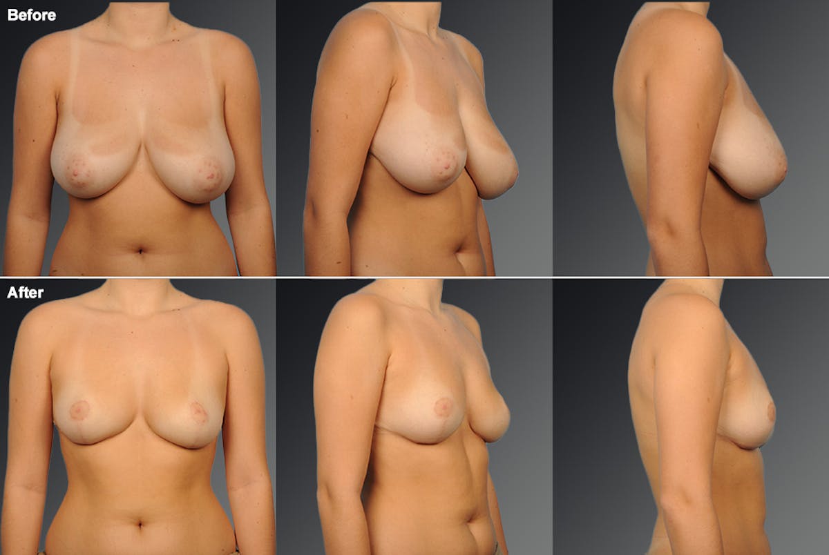 Breast Reduction Before & After Gallery - Patient 108673668 - Image 1