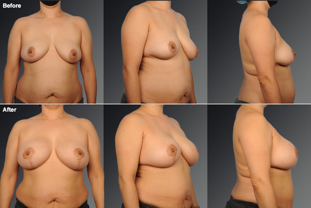 Breast Lift (Mastopexy) Before & After Gallery - Patient 108673701 - Image 1