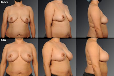 Breast Lift (Mastopexy) Before & After Gallery - Patient 108673701 - Image 1