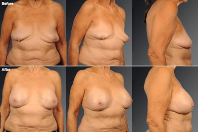 Breast Implant Revision Before & After Gallery - Patient 108616947 - Image 1