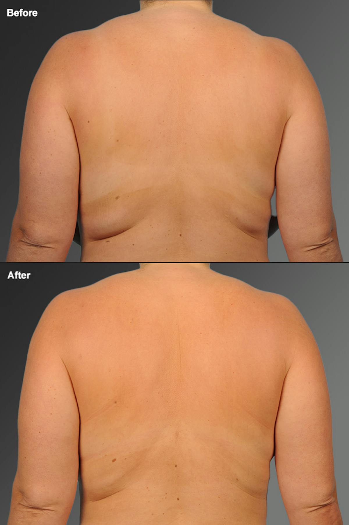 Liposuction Before & After Gallery - Patient 108676389 - Image 1