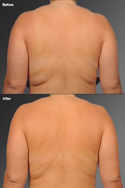 Liposuction Before & After Gallery - Patient 108676389 - Image 1