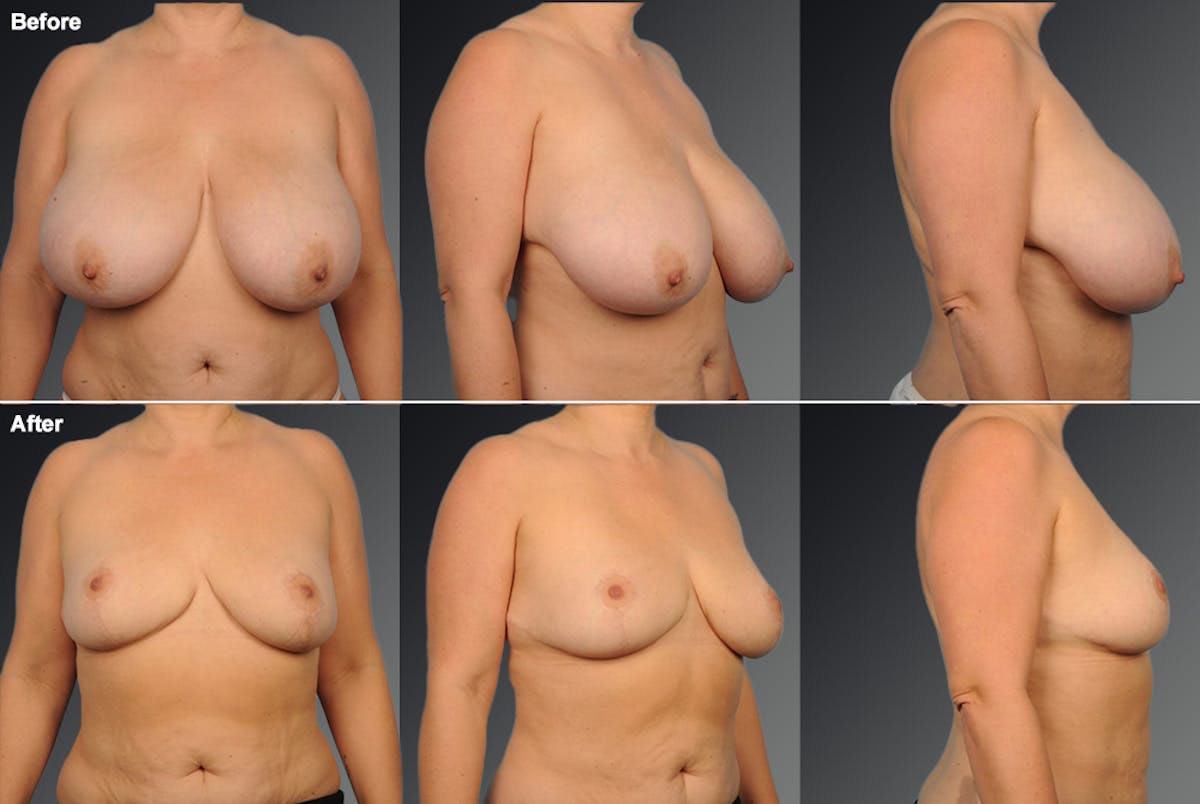 Breast Reduction Before & After Gallery - Patient 108673662 - Image 1