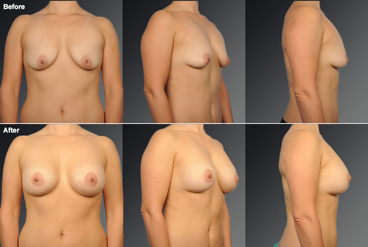 Breast Donut Lift Before & After Gallery - Patient 108617010 - Image 1