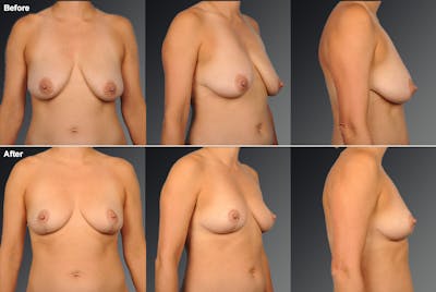 Breast Lift (Mastopexy) Before & After Gallery - Patient 108673702 - Image 1
