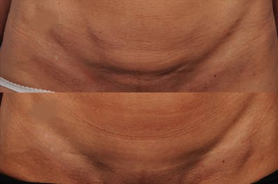 C-Section Scar Revision Before & After Gallery - Patient 114188434 - Image 1