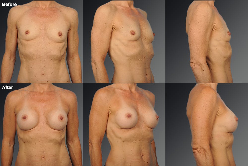 Breast Augmentation Before & After Gallery - Patient 108676380 - Image 1