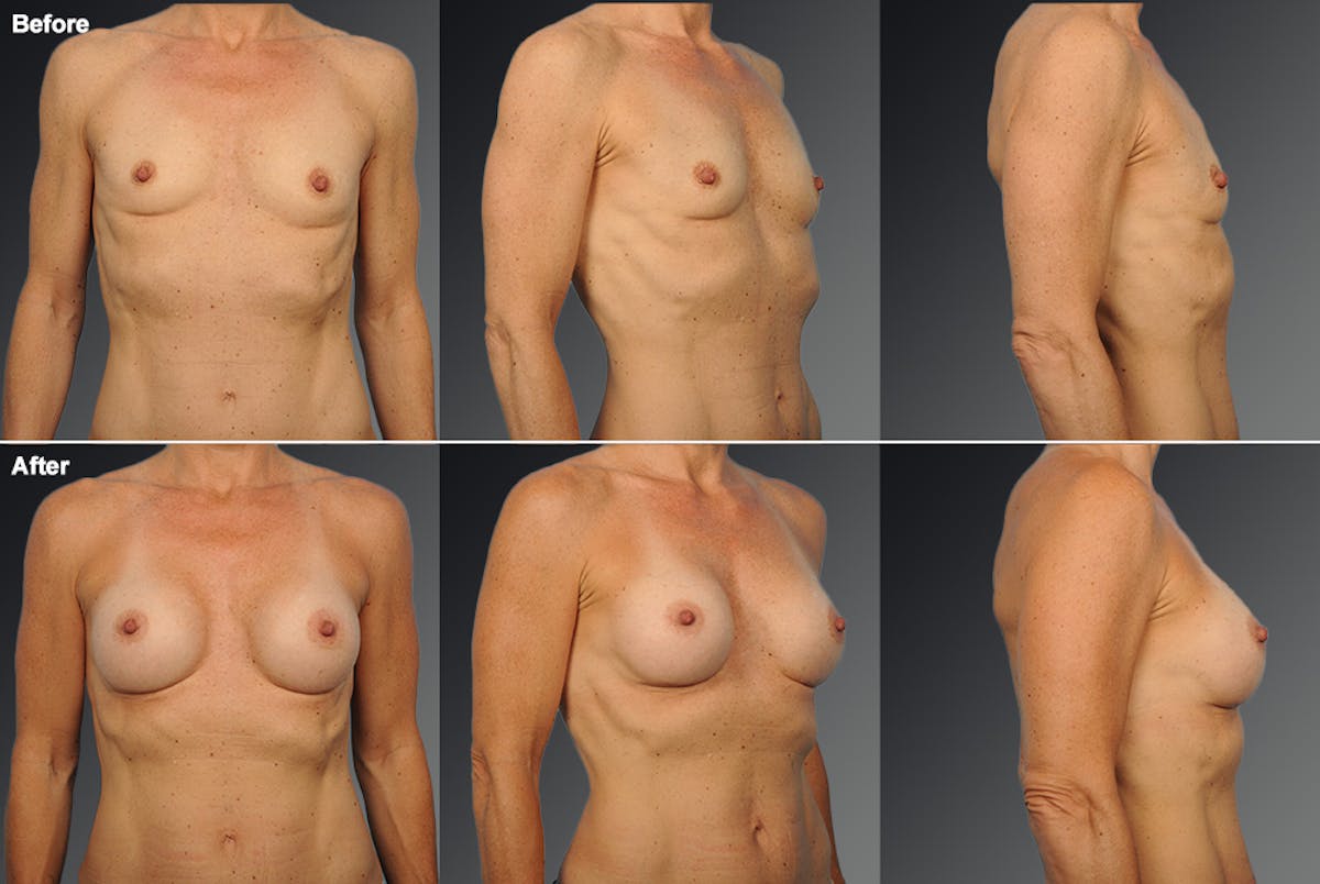 Breast Augmentation before & after
