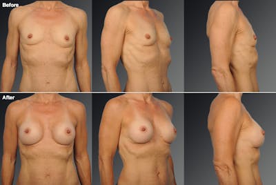 Breast Augmentation before & after