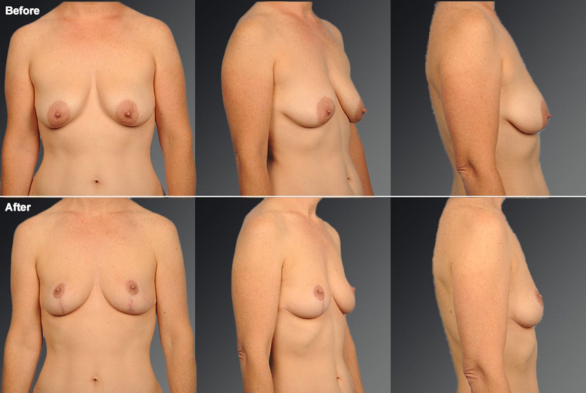 Breast Lift (Mastopexy) Before & After Gallery - Patient 108673703 - Image 1