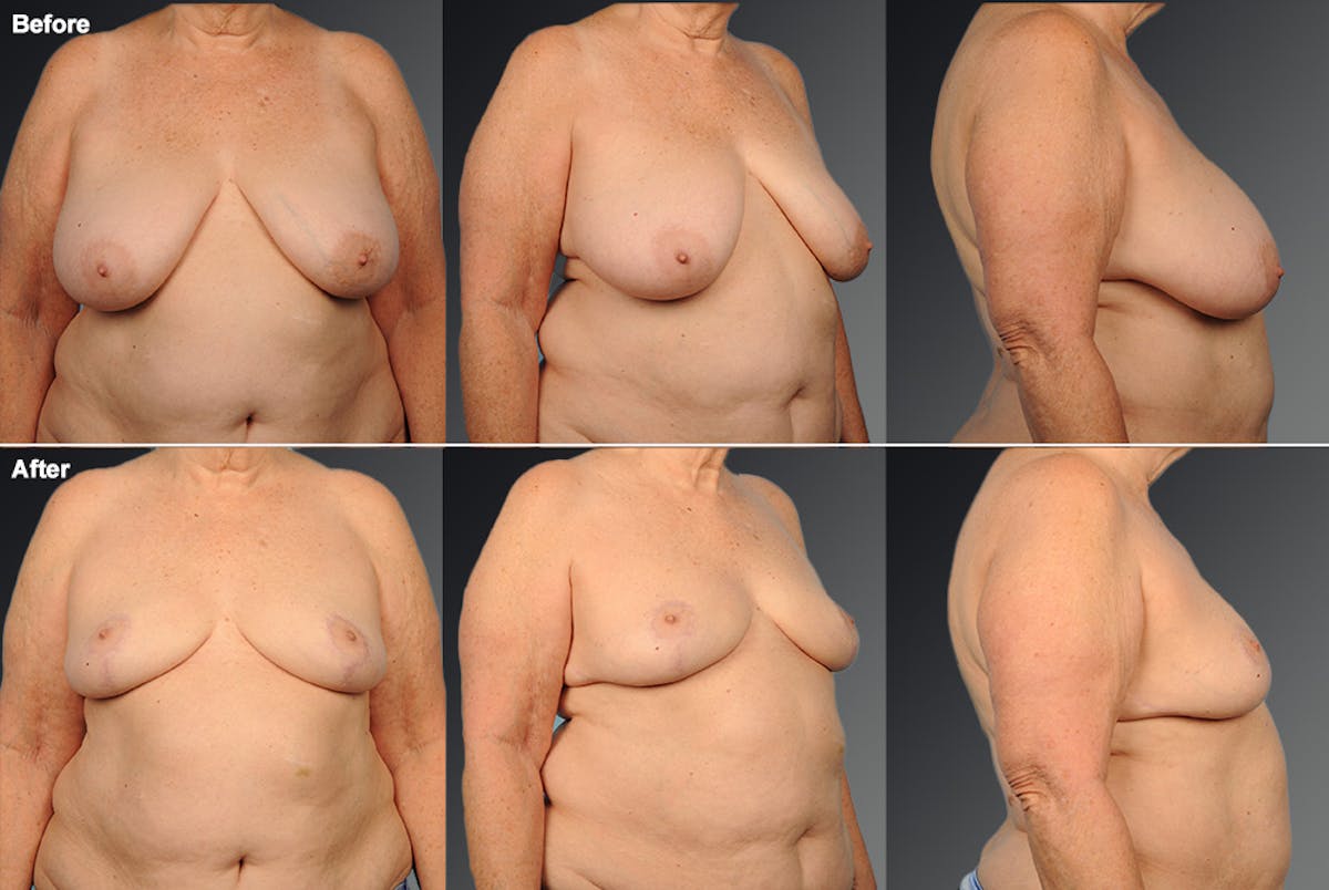 Breast Reduction Before & After Gallery - Patient 108673649 - Image 1