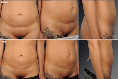 Body Scar Closeups Before & After Gallery - Patient 108676424 - Image 1