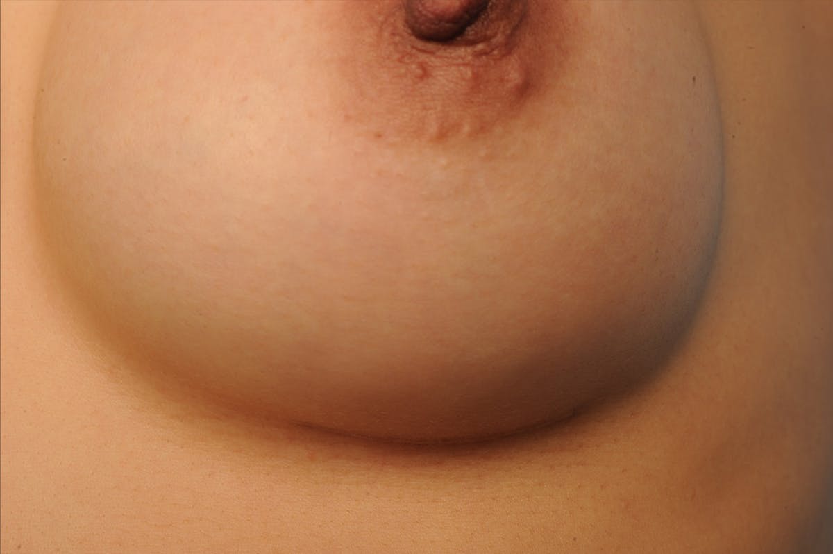Breast Scar Closeups Before & After Gallery - Patient 108616982 - Image 1