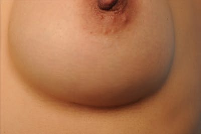 Breast Scar Closeups Before & After Gallery - Patient 108616982 - Image 1