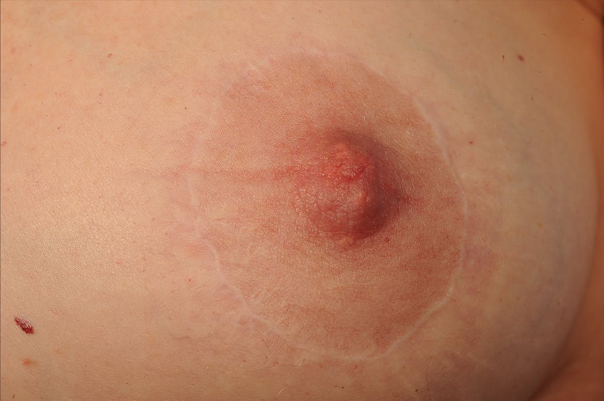 Breast Donut Lift Before & After Gallery - Patient 108673562 - Image 1