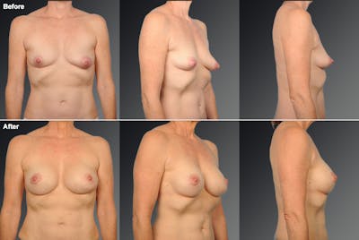 Breast Donut Lift Before & After Gallery - Patient 108673561 - Image 1
