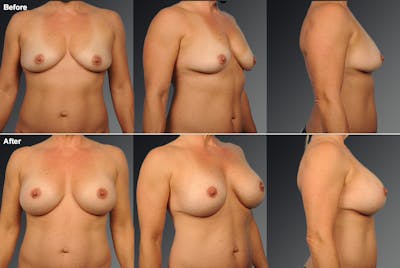 Breast Donut Lift Before & After Gallery - Patient 108673563 - Image 1