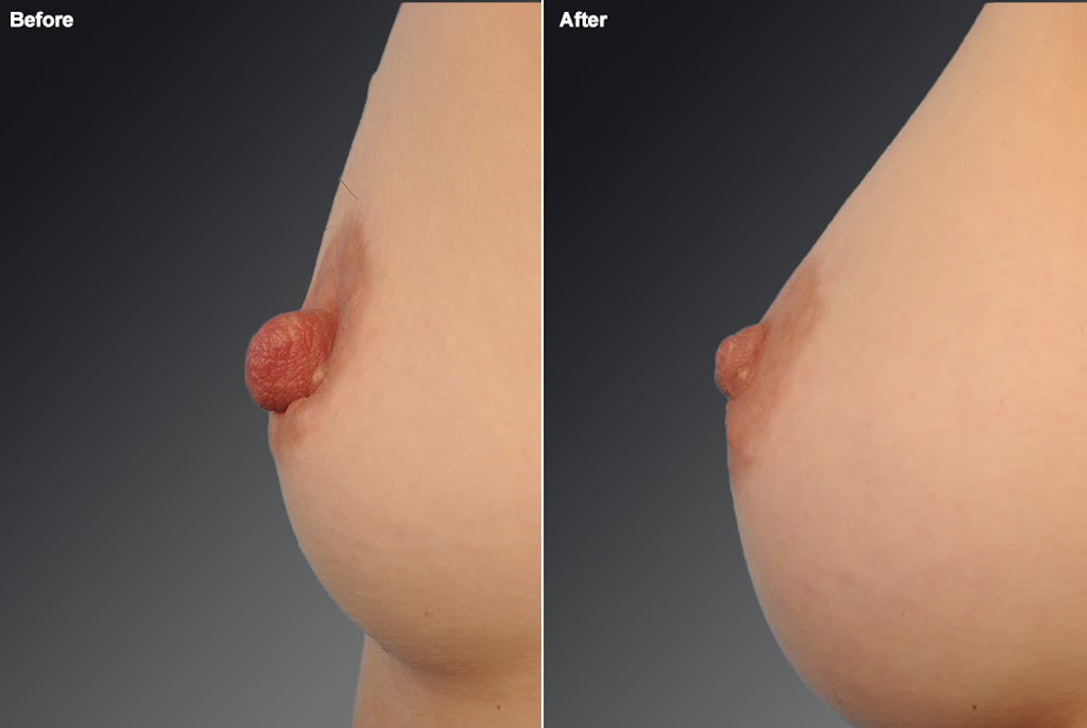 Nipple Reduction Before & After Gallery - Patient 108616976 - Image 1